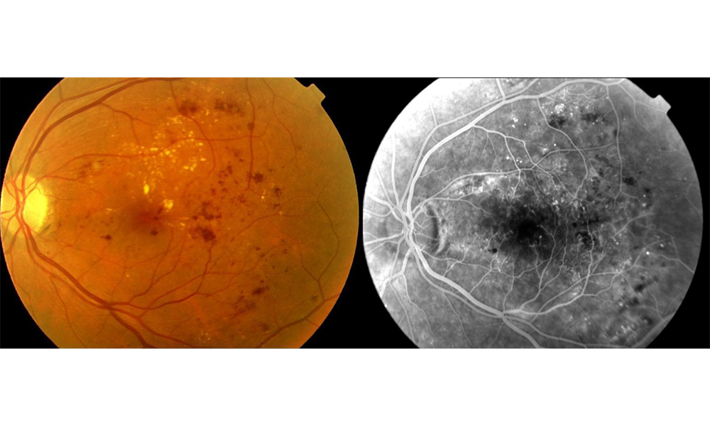 Retina Hastalıkları